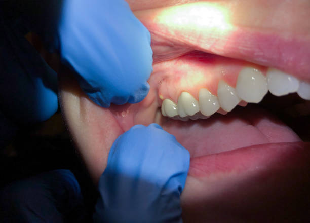 Best Emergency Cosmetic Dentistry (e.g., broken veneers) in Murphys, CA