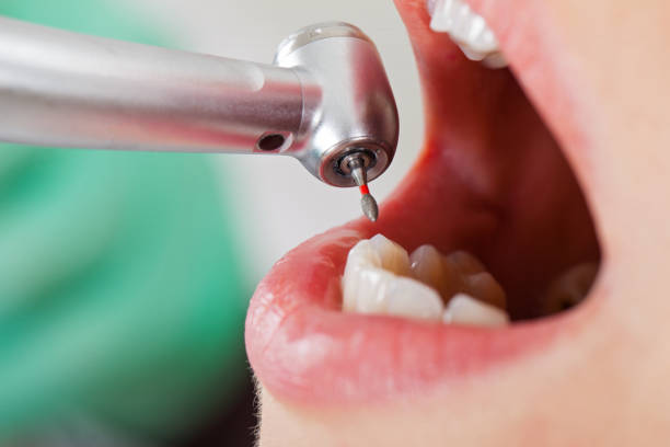 Best Broken or Chipped Tooth Repair in Murphys, CA